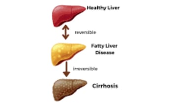 stages of fatty liver diseases