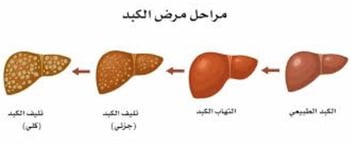 _احذروا المصير المحتوم للكبد الدهني وتشمع الكبد وتليف الكبد ودوالي المريء وسرطان الكبد (2)
