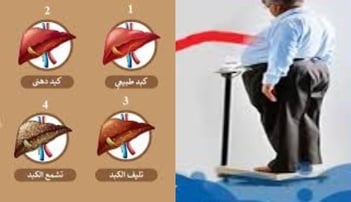 السمنة عامل الخطر الاكبر