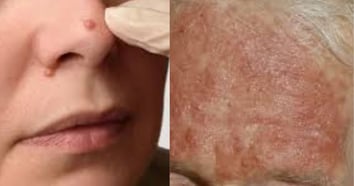 Fatty Liver Disease Can Show Up on Your Face