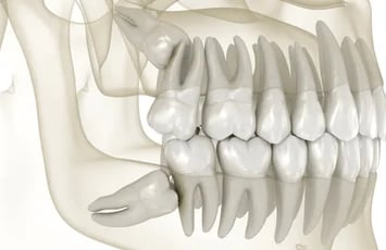 impacted wisdom tooth below bone