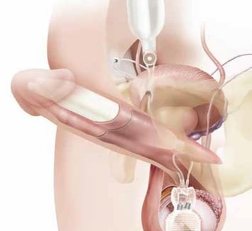 protesi peniena tricomponente