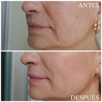 Relleno ácido hialurónico pliegues nasogenianos antes y después