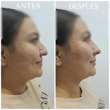 Rinomodelación perfil nariz curva antes y después