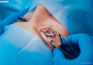 Refractive Surgery