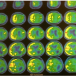 PET CT after surgery