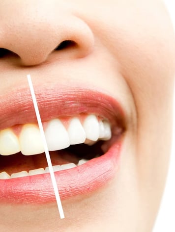 portrait-photo-retouching-teeth-whitening