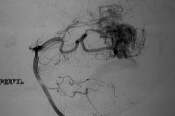 Angiografia vértebro-basilar projeção perfil mostrando a MAV.