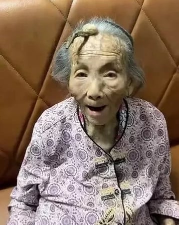 idosa chinesa de 107 anos com chifre na testa osso na cabeça