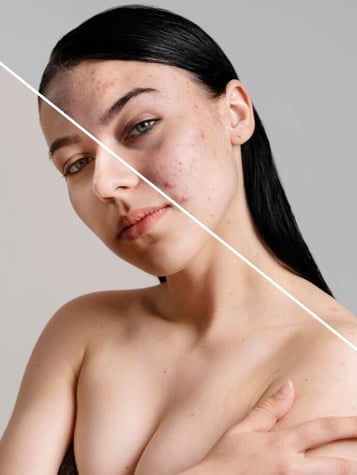portrait-photo-retouching-blemish-and-scar-removal
