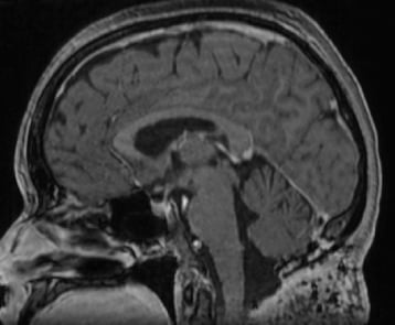 Ressonância magnética após a cirurgia mostrando a retirada total do tumor.