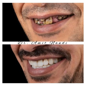 smile designing by dentist amit nandi kolkata