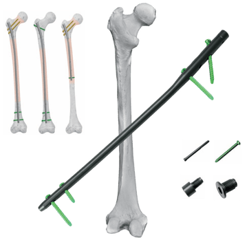 Clavo Intramedular para Fémur