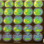 PET CT before surgery