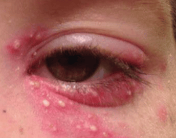 herpes simplex