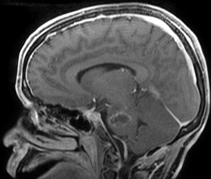 Ressonância corte sagital após a cirurgia no cérebro e remoção total do cavernoma.