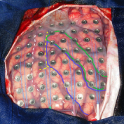Imagem intraoperatória com uso de placa subdural.