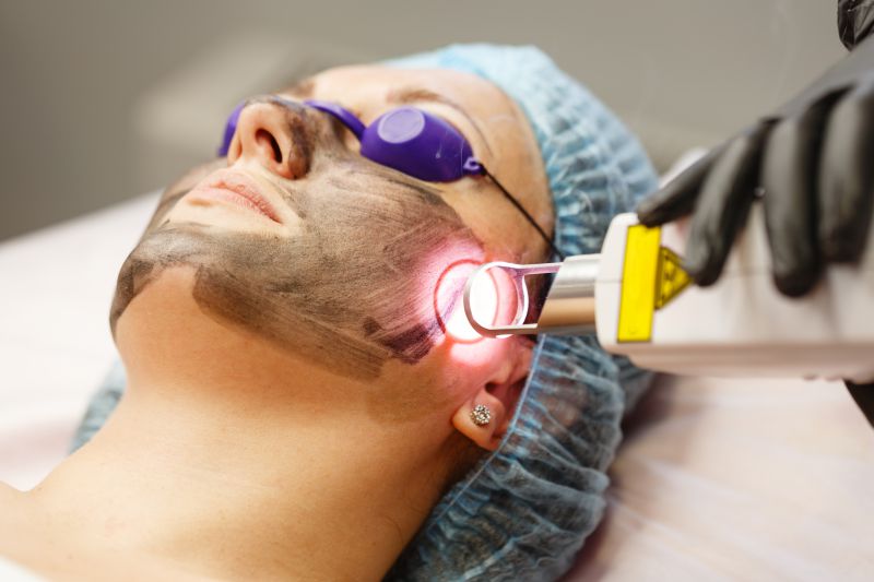 Limpieza facial con carbón activo e IPL en Sevilla