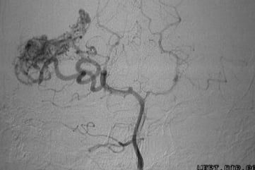 Angiografia vértebro-basilar projeção frontal mostrando a MAV.