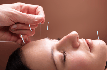 acupuntura facial. dor de cabeça. relaxamento. tratamentos naturais. saúde natural.