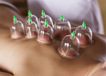 ventosa. ventosaterapia. medicina chinesa. terapia natural. tratamento de dores massagem com ventosa