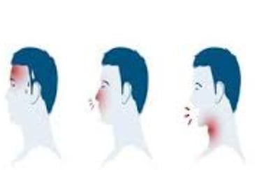 صداع التهاب بالانف كحة اعراض