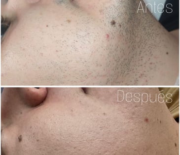 Mejora en cicatrices de acné y textura facial con láser en Tu Piel Láser Center Bogotá