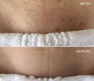 Antes y después de tratamiento láser para foliculitis en zona íntima femenina