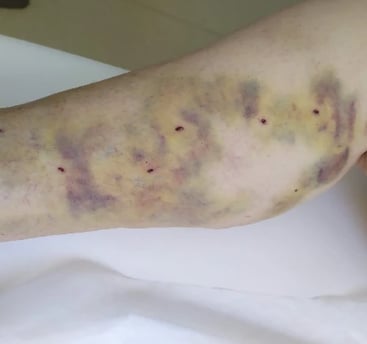 a person with a wound wound on their leg