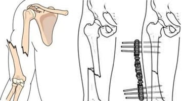 bone break down