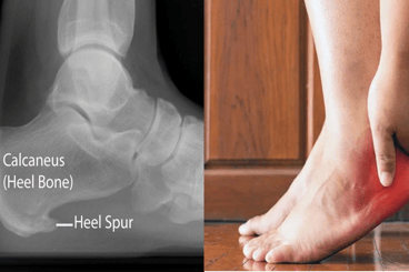 Calcaneal spur