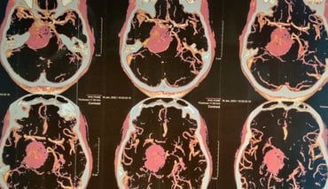 Large petroclival meningioma