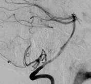 Angiografia digital projeção perfil após a cirurgia no cérebro e clipagem do aneurisma cerebral.