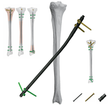 Clavo Intramedular para Tibia