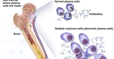 abnormal plasma cells