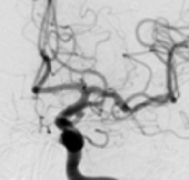Angiografia digital projeção frontal após a cirurgia no cérebro e clipagem do aneurisma cerebral.