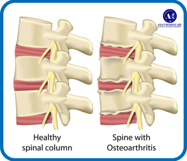 OA Spine