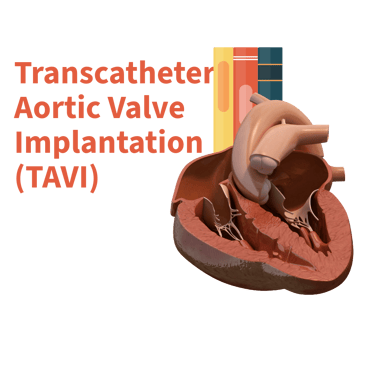 Transcatheter Aortic Valve Implantation (TAVI) is Minimal Invasive Technique to address Heart Valve problems. logo