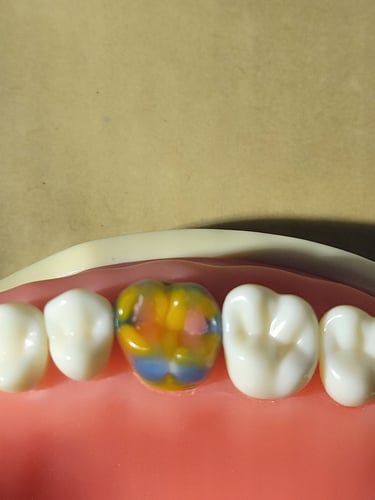 Occlusal view of a multi-colored dental wax depiction of the permanent maxillary left first molar.
