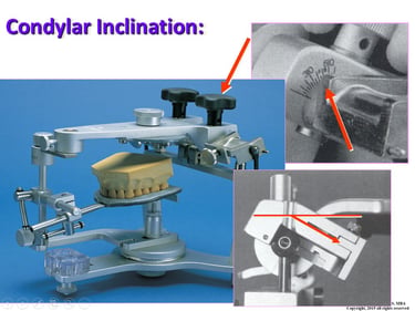 Image of an Articulator with a Facebow mounted maxillary cast depicting condylar inclination.