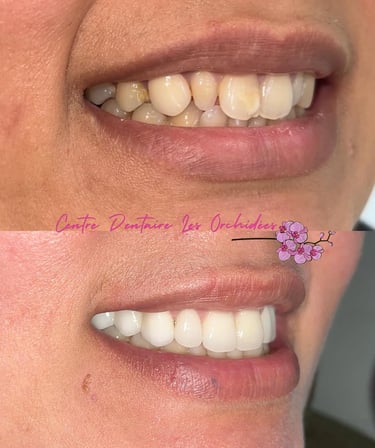 Résultat naturel d’une transformation du sourire esthétique Mohammedia