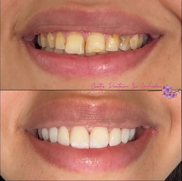 facettes pour changement de sourire à Mohammedia