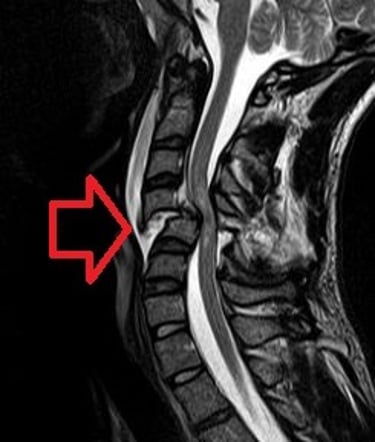 Cervical Spine MRI of patient with SCI: C4 fracture and dislocation.