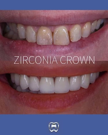 zirconia crown in dental academy
