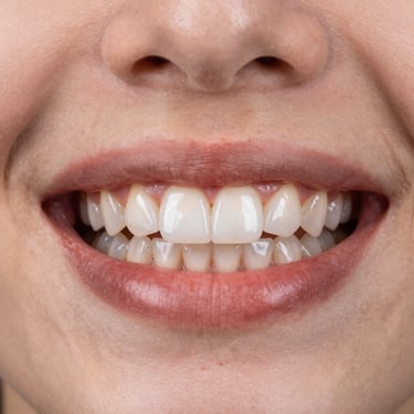textura y anatomía de dientes anteriores