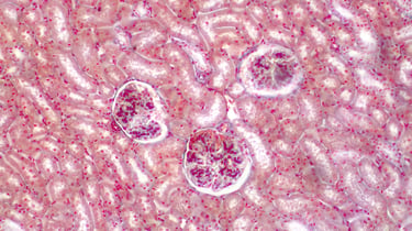 glomerulopatia histologia riñon autoinmune
