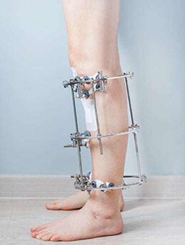 "Quem tem direito ao auxílio-acidente" "Valor do auxílio-acidente 2026" "Como pedir auxílio-aciden