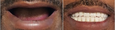 All on four dientes de porcelana