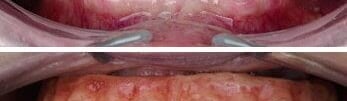 Patient with broken teeth restored with permanent All-On-4 crystal clear bridge