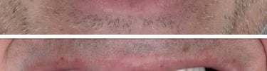 Patient receives full arch restoration with immediate load All-On-4 bridges